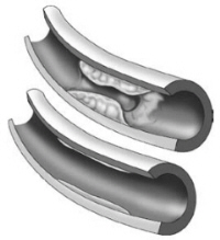 Coronary artery restored to health with Pauling's Lp(a) binding inhibitors and no longer in need of reinforcing plaque